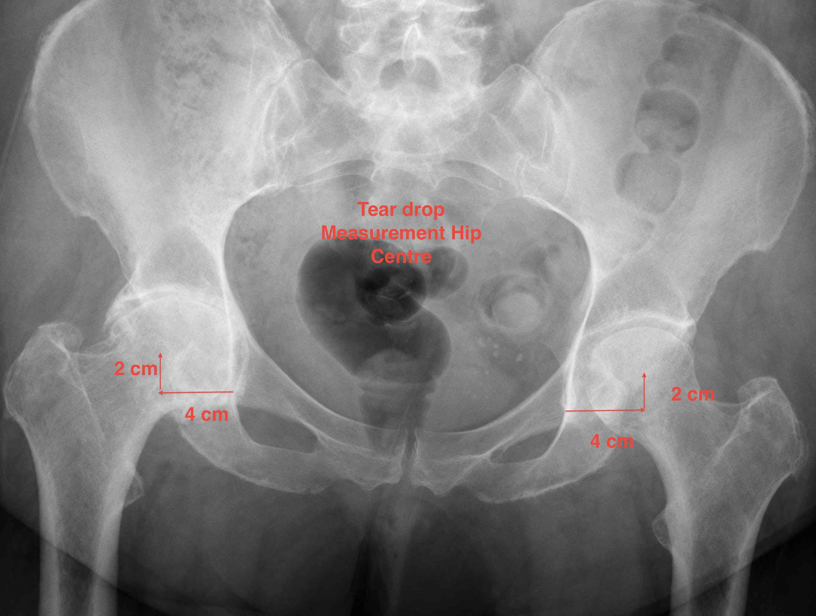 Hip Protrusio Teardrop Method Centre Rotation